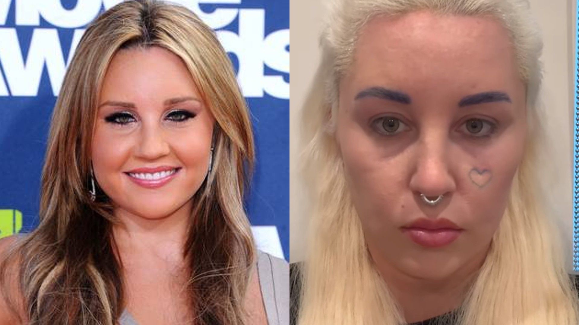 Amanda Bynes antes y después de la blefaroplastia